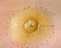 EMF effects on keratinocytes: experiments